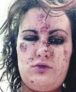 The injuries Gemma Hasson sustained in brutal sectarian attack