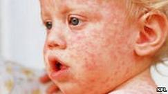 An outbreak of the measles virus on a baby's face