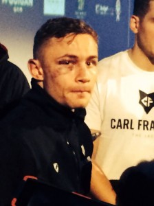 World champion Karl Frampton sports his bruises after a tough fight with Martinez
